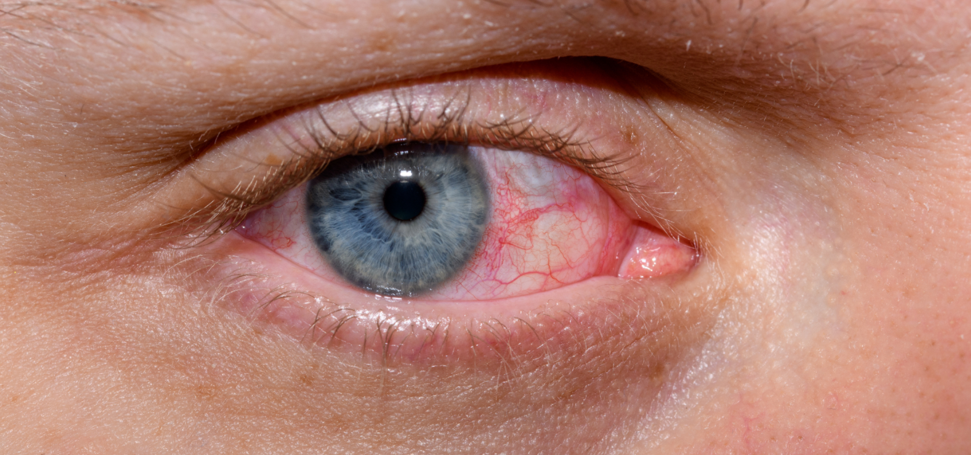 Olhos vermelhos e ardendo: causas e tratamento