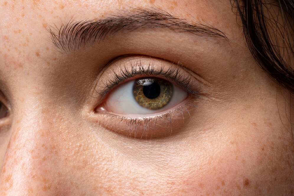 Ptose Palpebral: causas, sintomas e como corrigir