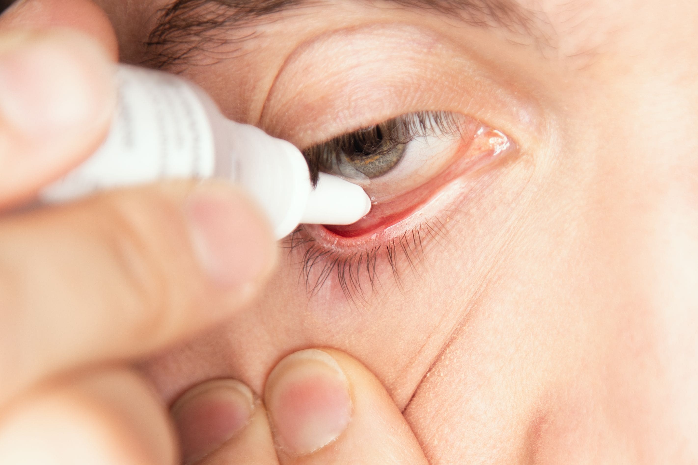 Tratamento para glaucoma: existe cura para a doença?
